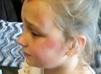 A ten-year-old girl suffered a broken arm after she was struck by a "knife-wielding" boy dressed as a killer CLOWN. See SWNS story SWCLOWN. Casie Morrison, ten, was playing in the park with her siblings when a figure emerged from the bushes dressed as a creepy clown wearing a Slender Man mask. Mum Kirsty, 36, told the boy - who was reportedly carrying a KNIFE - to clear off, and he fled when older boys in the park gave chase. But the boy barged passed Casie, who was on her bike at the time, causing her to fall to the ground and suffer a broken arm as well as cuts and grazes. Her furious mum said the boy was trying to terrifying other kids in the park and she has since found out he was aged just NINE. Police were called following the incident and have spoken to the boy responsible.